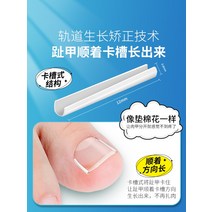 내성발톱교정기 네일 염증 개스킷 아티팩트 교정기 임베디드 특수 격리 발톱은 수정 스티커를 채우기 위해 살로 자랍니다., [06] 심한 내향성손톱 전용 재발방지 교정기술