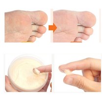 각질용해제 굳은살 발뒤꿈치갈라짐 연고 발바닥각질 각화형 무좀 제거크림 발바닥 보습제