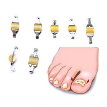 ANVAVA 스트레치링 내성발톱 교정기 세트