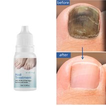 [당일배송] 1 1 발톱무좀치료 발톱 케어제 발톱연화 발톱 무좀 관리, 10ml × 2개, 2개, 1개입