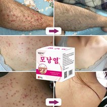 피부가려움증 습진연고 지루성피부염 건선 크림 얼굴 여드름 연고, 30g, 1개