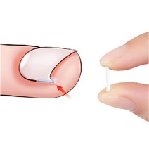 발톱스틱 자가치료 교정기10pcs 파고드는 네일 굽은발톱 추천템 발톱케어 테이프 커브스틱