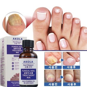 Nail epai Essence 네일 트리트먼트 영양액 트리트먼트 로션 손톱 발톱 전용액, 1개, 10ml