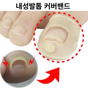 내성발톱 파고드는발톱 문제성발톱 자가치료 교정기