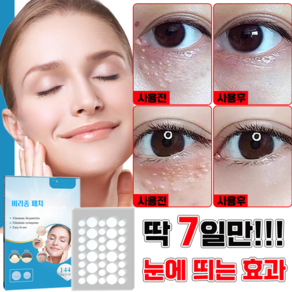 [국내배송] 눈가 비립종 제거 패치 눈밑 지방 입자 제거 패치 한관종 매립종 제거 밴드, 2개, 144개입