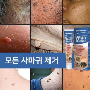 [미국수입원]제거율 99.99 세이프티 포뮬러쾌속적 유효비립종제거편평사마귀얼굴사마귀사상사마귀LK020, 1개, 20g