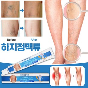 하지정맥류 크림 정맥류 연고 혈관염 다리부종 혈액순환 붓기크림 포장증정