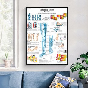 노 브랜드 VARICOSE VEINS 인간 차트 포스터 굴절 캔버스 인쇄 벽 사진 의료 교육 병원 홈 장식, no fame