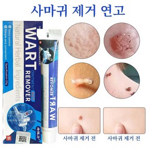 [국내배송]사마귀 피부 치료/강력한 사마귀 제거/일주일의 이별/편평사마귀/얼굴 사마귀/닭의 눈/좁쌀알/증세W033