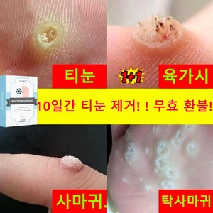 [국내배송] 티눈 밴드 티눈제거 밴드 보호테이프 발바닥 통증 풋케어, 2개