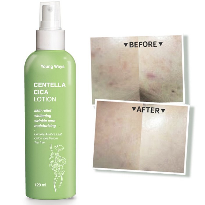 영웨이즈 센텔라 시카 로션  티트리  병풀  봉독  어성초 여드름, 1개, 100ml