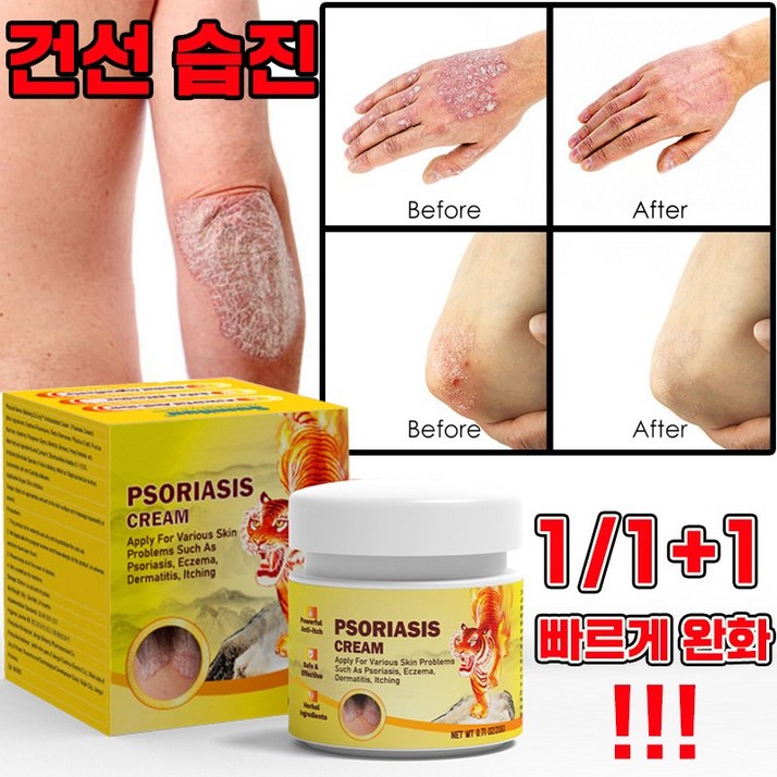 빨른 배송 미국 건선 연고 치료제 두드러기 가려움 연고 피부 가려움증 허브 크림
